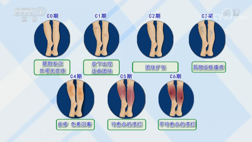 別讓“蚯蚓”爬上你的腿