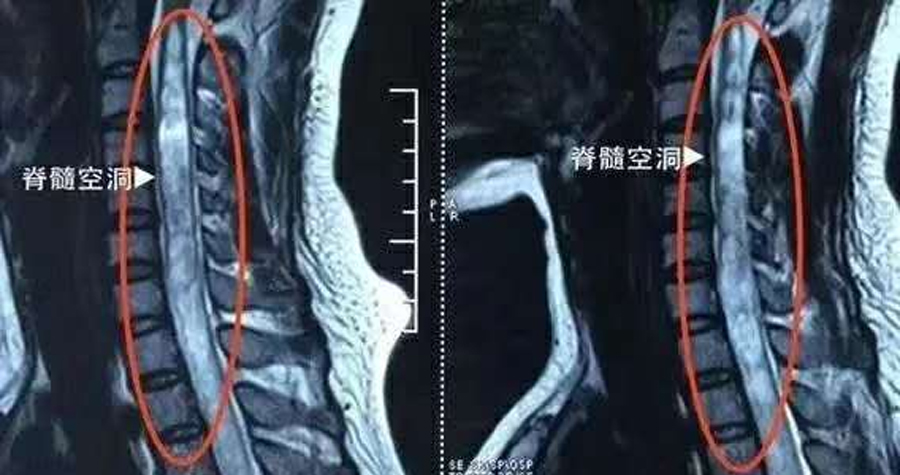 人造脊髓植入物有望使癱瘓者恢復(fù)行走